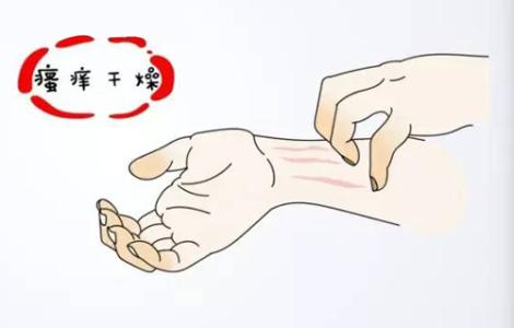 牛皮癣的发生是不是咽炎