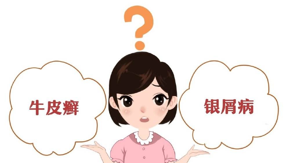 广州专门治疗牛皮癣的医院