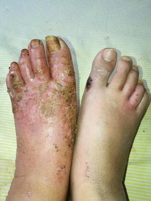 银屑病患者都关注的症状